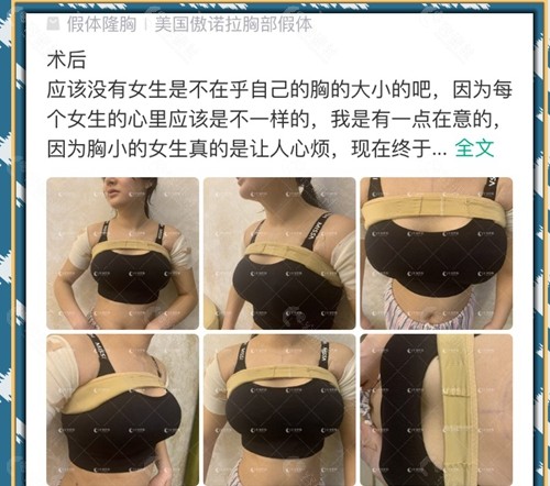 求美者在郑州华领整形医院做假体隆胸评价