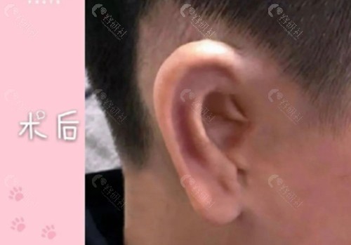 耳再造术过程详解