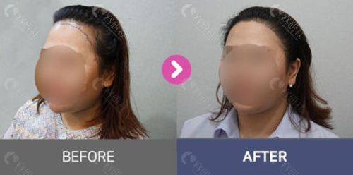 韩国moplus毛发移植医院发际线种植前后图片