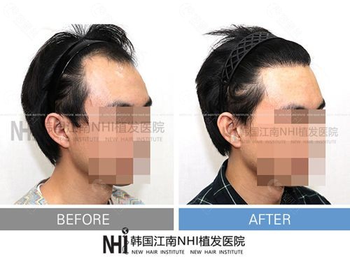 韩国江南NHI植发医院发际线种植前后图片
