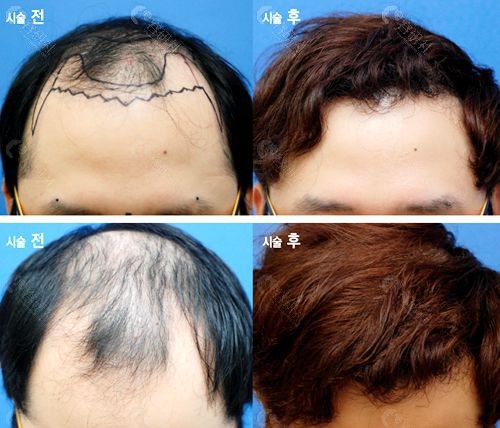 韩国（The black）布莱克毛发移植医院男士发际线种植前后图片