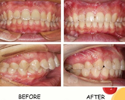 广州马泷齿科牙齿矫正前后对比照