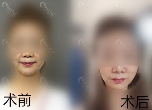 北京加减美穆宝安拉皮手术前后对比照