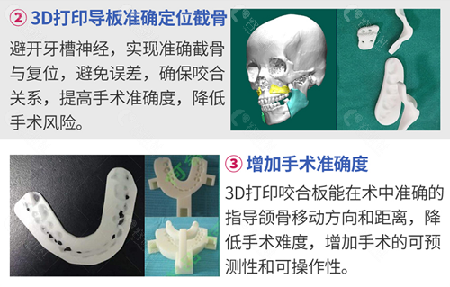 广大医院3D导板技术