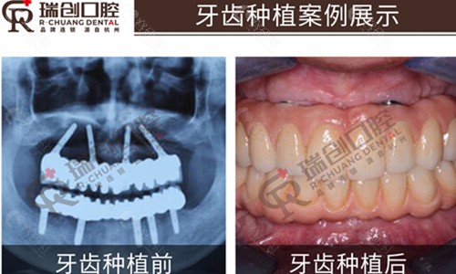 杭州瑞创口腔医院种植牙前后对比图