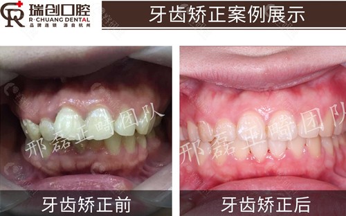 杭州瑞创口腔医院牙齿矫正前后对比照
