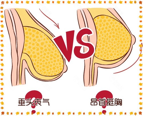 國內做乳房下垂矯正好的醫院前十彙總含口碑醫生收費價格