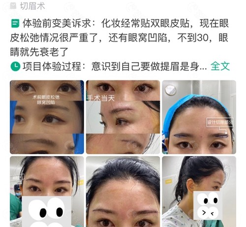 网友在深圳福雅医疗美容做提眉反馈评价