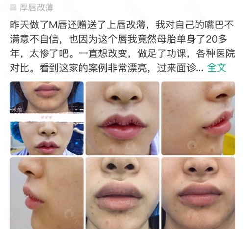 网友在深圳福雅医疗美容做厚唇改薄反馈评价