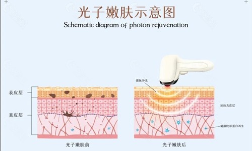 光子嫩肤能改善哪些皮肤问题？