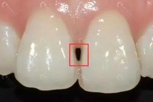 牙龈黑三角怎么修复