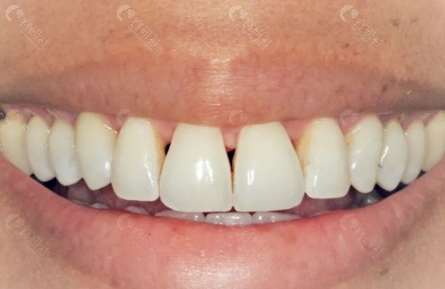 牙齿黑三角修复方式