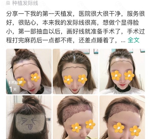 网友在广州青逸植发医院做毛发种植评价