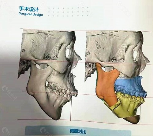 周会喜正颌手术方案设计