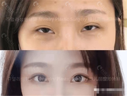 韩国珠儿丽整形外科医院双眼皮修复靠谱吗