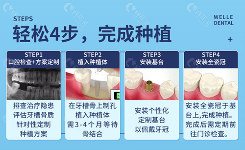 上海维乐口腔种植牙步骤