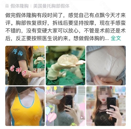 网友找上海时光医院许黎平医生隆胸评价
