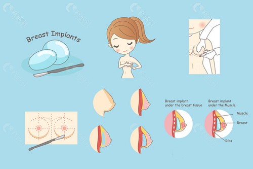 假体隆胸手术介绍
