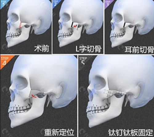 杭州时光医疗美容下颌角磨骨前后对比图