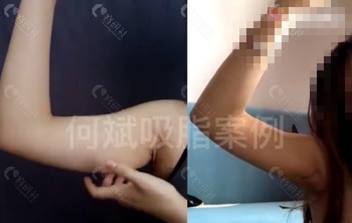 上海何斌医生做手臂吸脂手术对比图