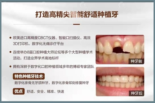 广州德伦口腔种植牙前后对比照