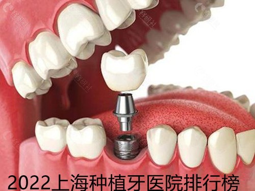 2022上海种植牙医院排行榜
