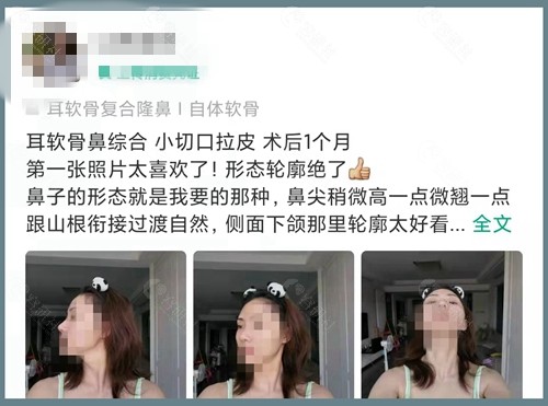 北京俊泰美好鼻修复后满意度高