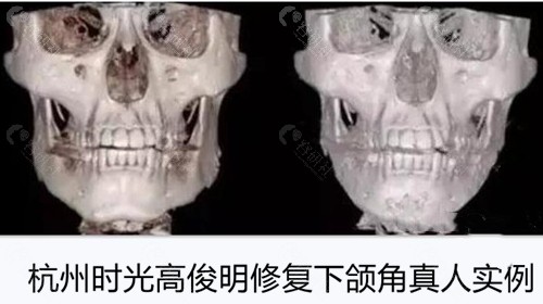 杭州时光高俊明3D打印人工骨修复下颌角前后对比图