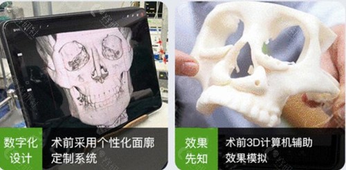 杭州3d打印人工骨修复手术流程