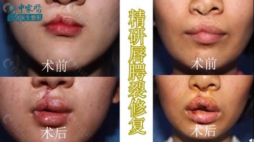 广州中家医家庭医生黄广香唇腭裂整形术前术后对比