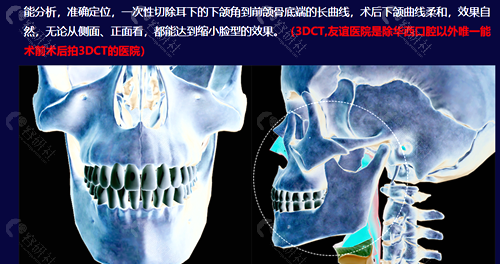 四川友谊医院做下颌角磨骨手术应用的3d内窥镜扫描技术