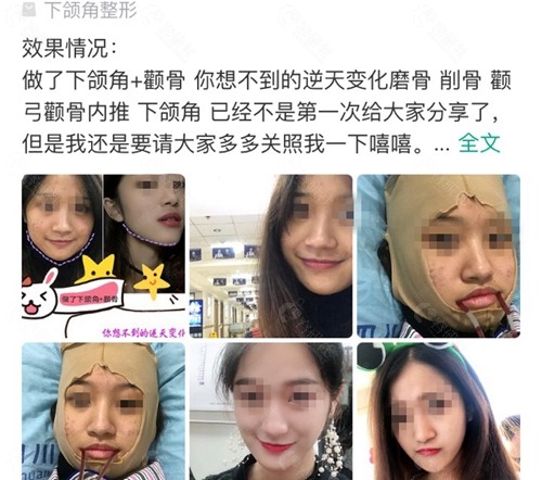 网友在四川友谊医院做下颌角磨骨手术评价