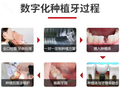 北京美冠塔口腔种植牙过程