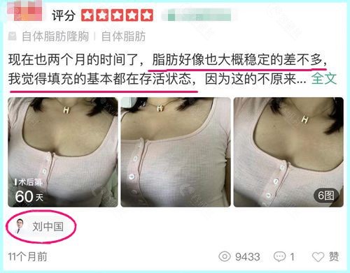 顾客对成都润美玉之光医疗美容刘中国医生自体脂肪隆胸术后真实评价