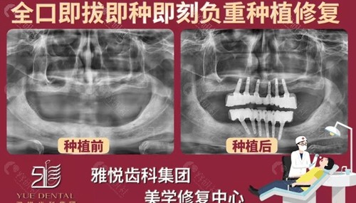 上海雅悦齿科种植牙怎么样？