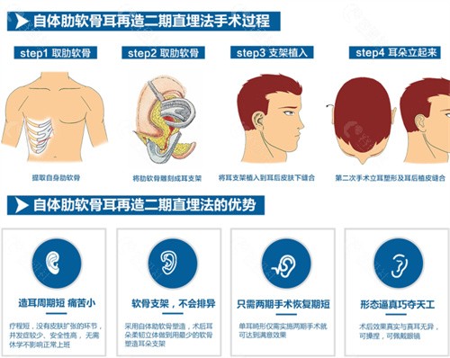 安波自体肋软骨耳再造优势