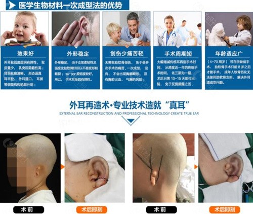 北京丽都生物耳支架耳再造优势介绍