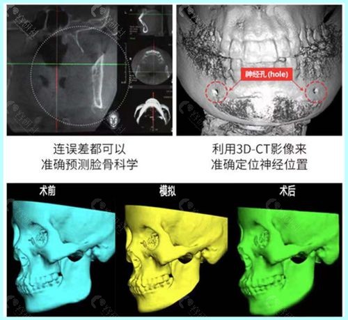 广州下颌角磨骨好的医生罗延平6D艺术改脸型技术优势