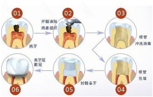 牙齿根管治疗及牙冠修复原理
