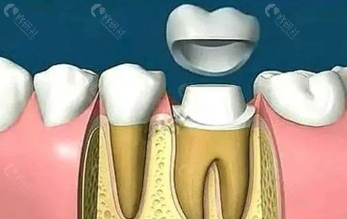 根管治疗后牙冠修复
