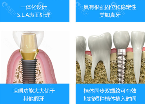 长沙优伢仕口腔种植牙优势