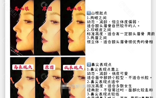 郑州美莱医疗美容医院隆鼻对比展示图
