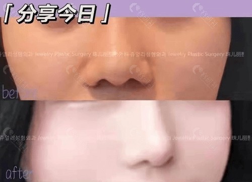 韩国珠儿丽垫鼻基底对比照