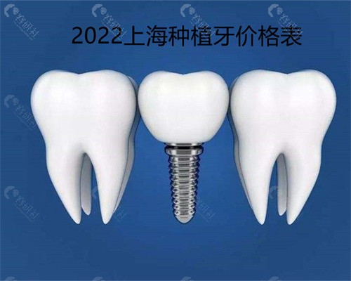2022上海种植牙价格表公布