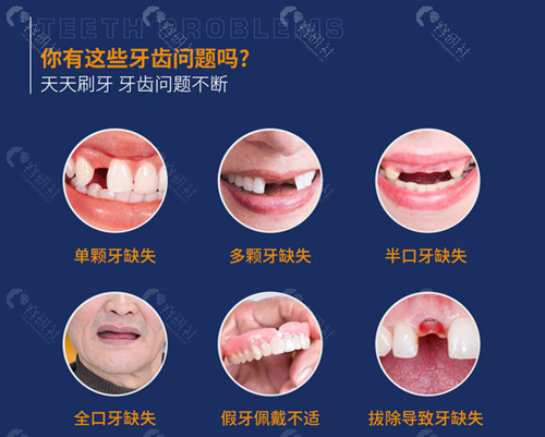 需要做种植牙的情况
