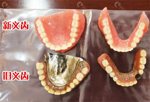全口吸附性义齿和胶连义齿相比有哪些优势