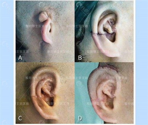 耳朵畸形做耳再造国内可以报销吗？