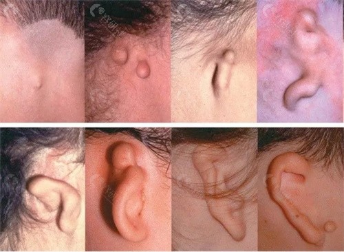 耳朵畸形做耳再造好的医院有哪些？