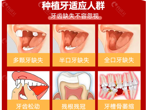 上海牙科医院种植牙适应人群