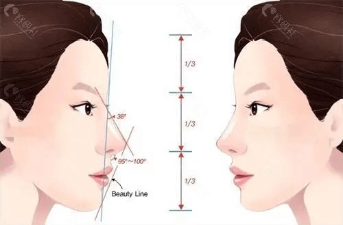 隆鼻后的鼻梁会容易坍塌吗?